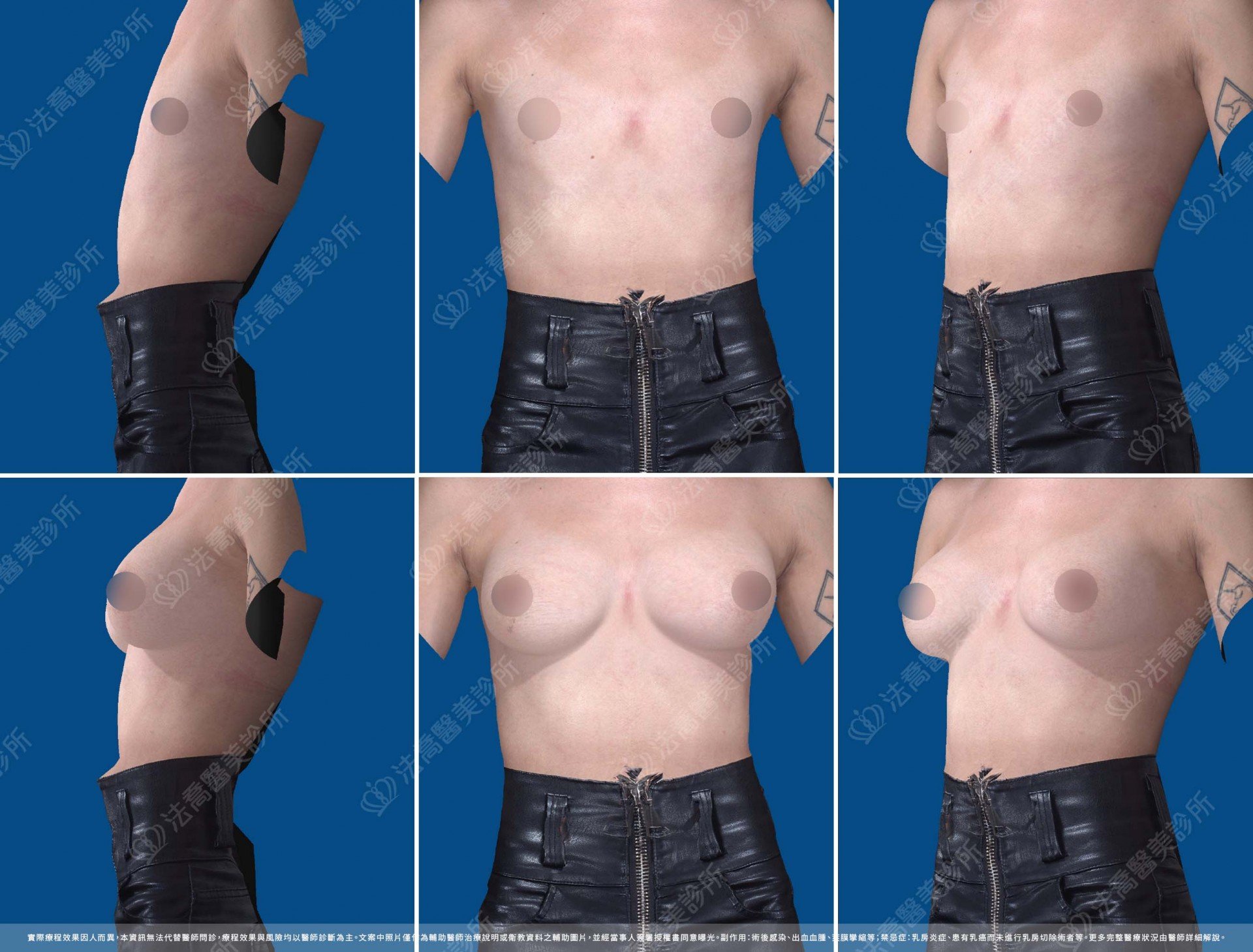 圓盤果凍隆乳,自體脂肪隆乳,3D影像模擬畫面