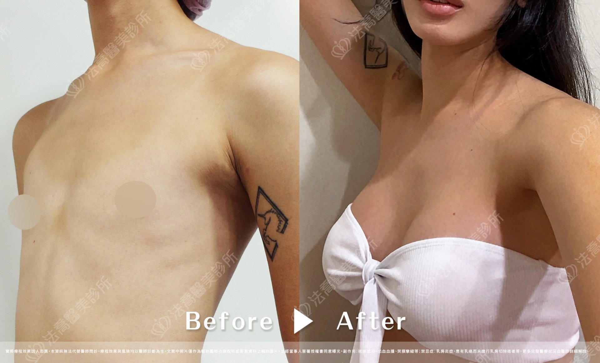 圓盤果凍隆乳,自體脂肪隆乳