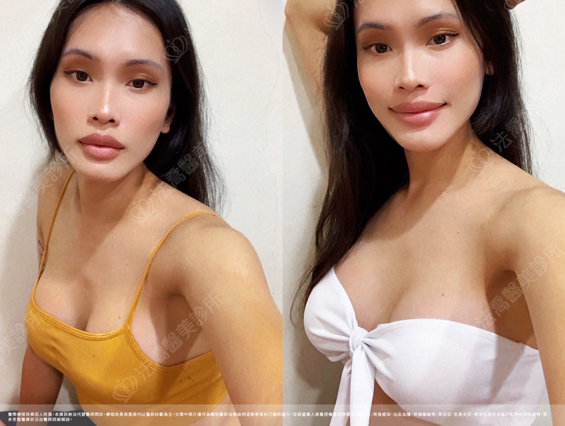 圓盤果凍隆乳,自體脂肪隆乳