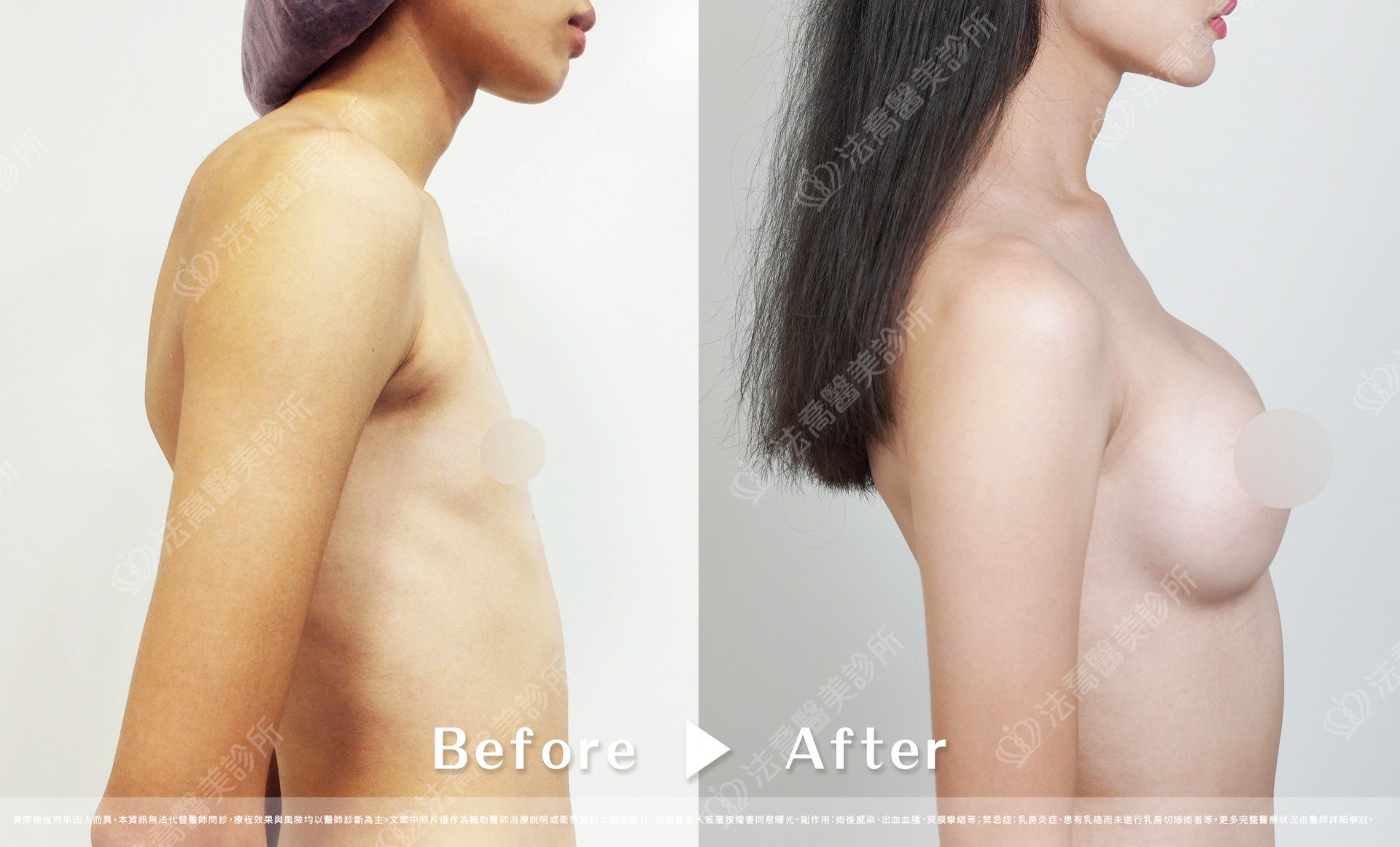 圓盤果凍隆乳,自體脂肪隆乳