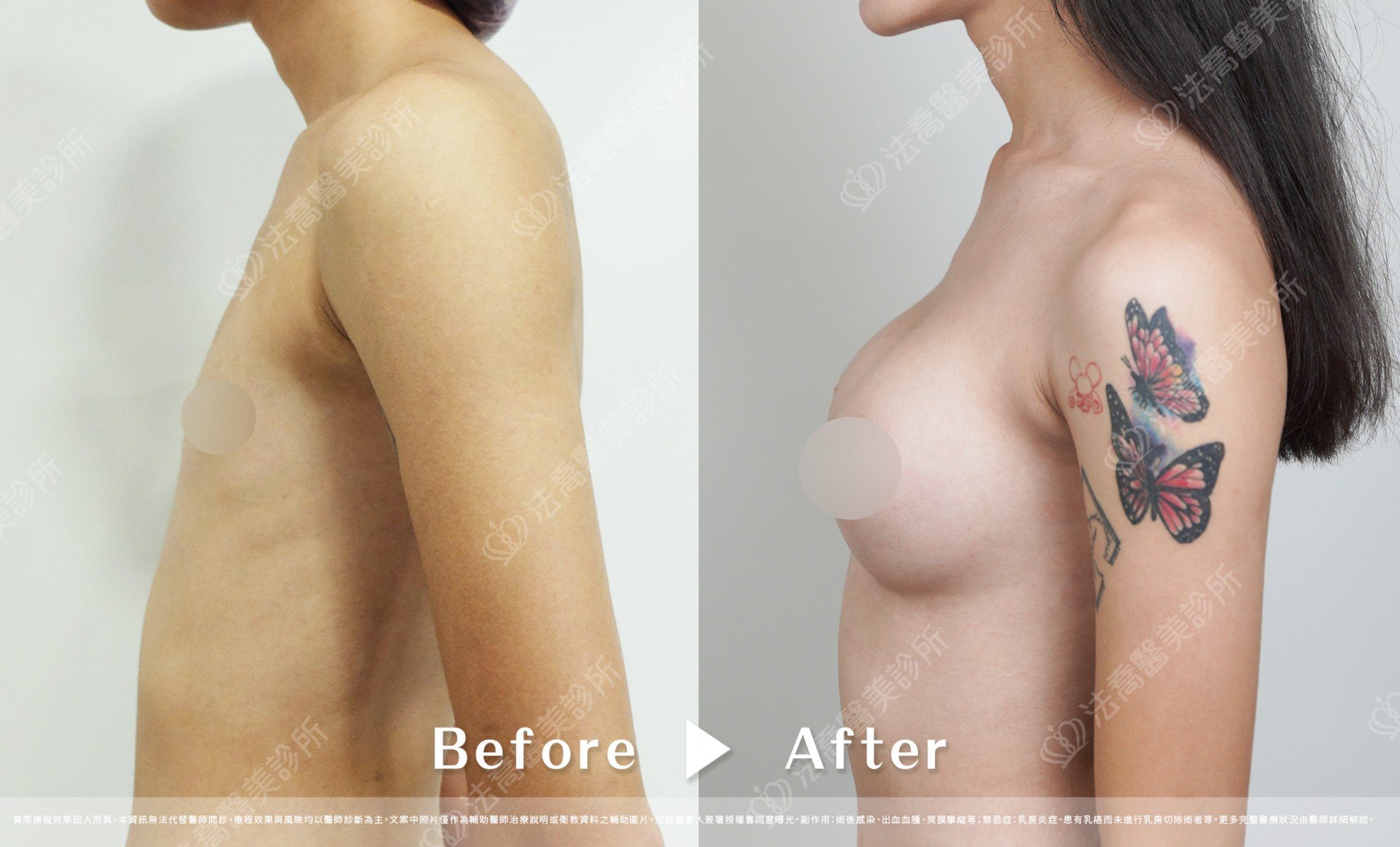 圓盤果凍隆乳,自體脂肪隆乳