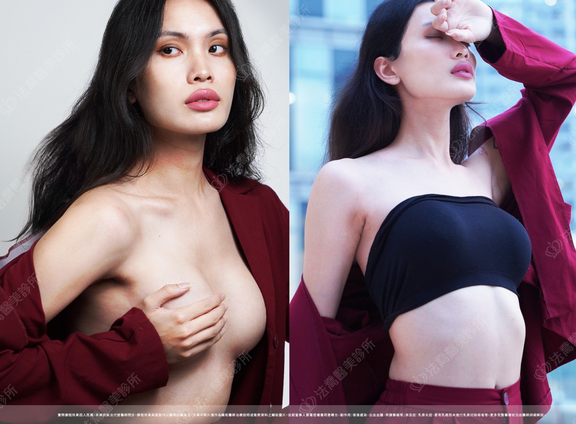 圓盤果凍隆乳,自體脂肪隆乳