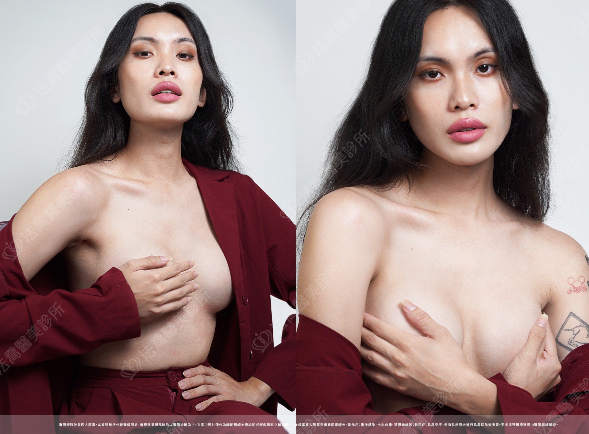 圓盤果凍隆乳,自體脂肪隆乳