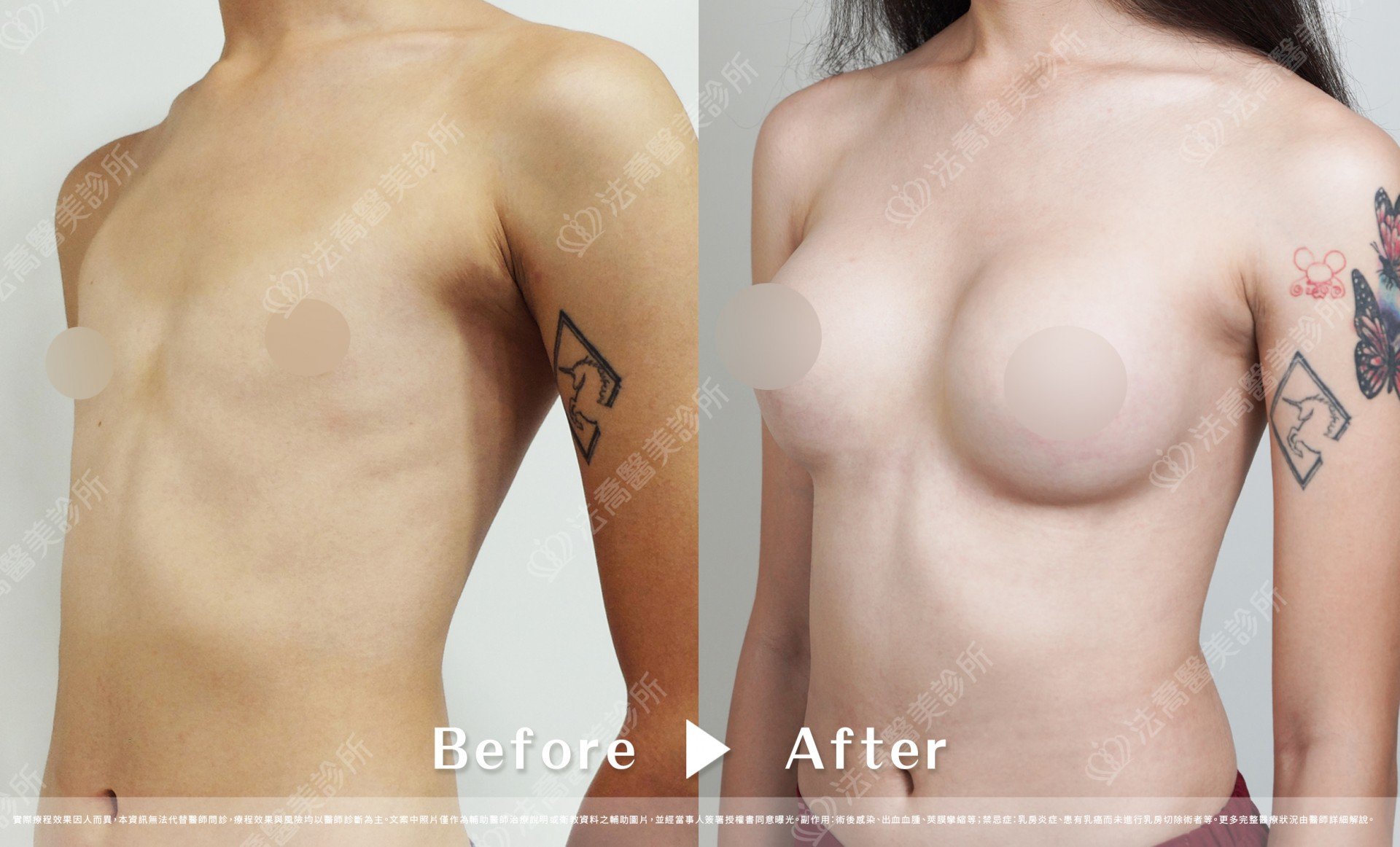 圓盤果凍隆乳,自體脂肪隆乳