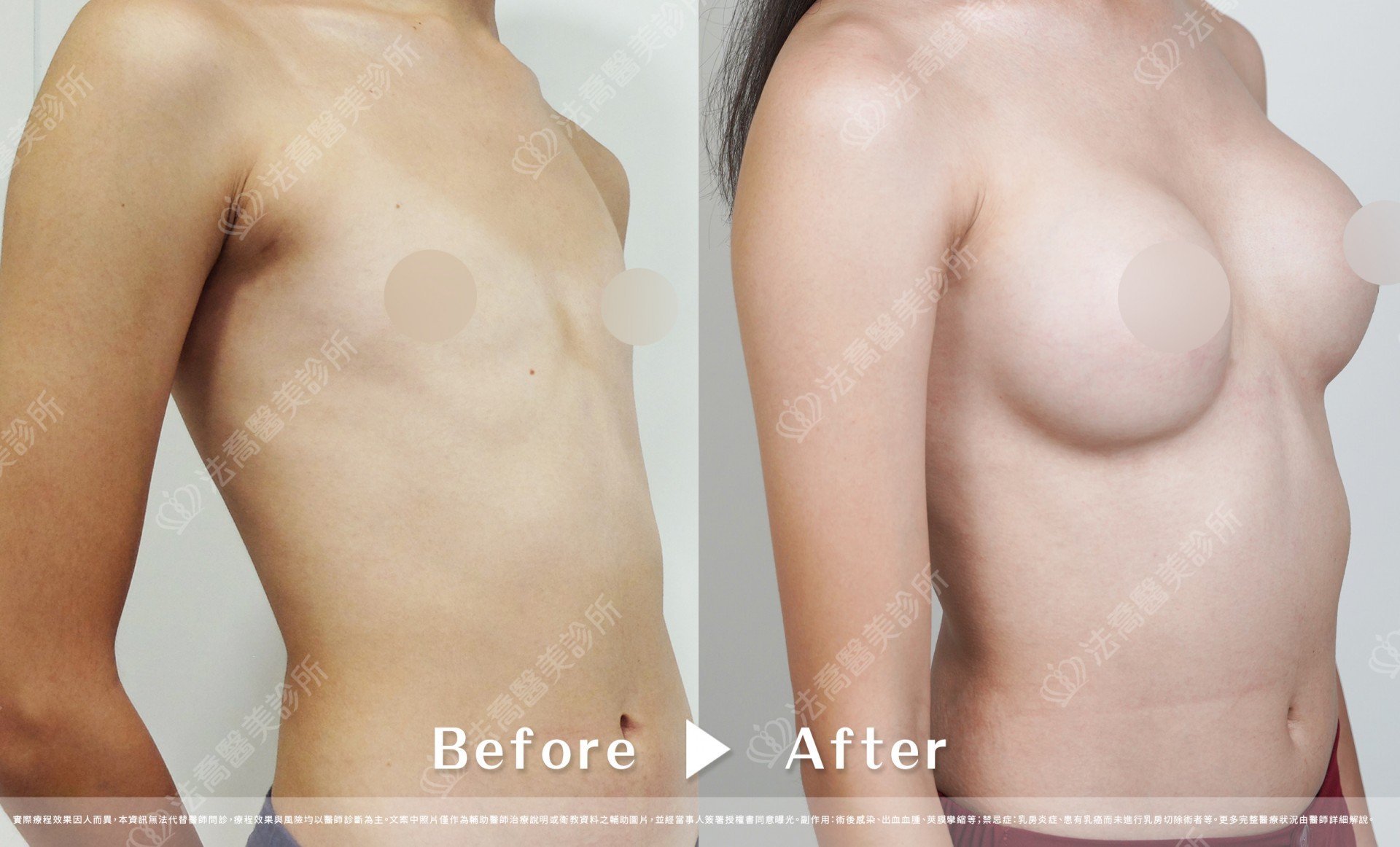 圓盤果凍隆乳,自體脂肪隆乳