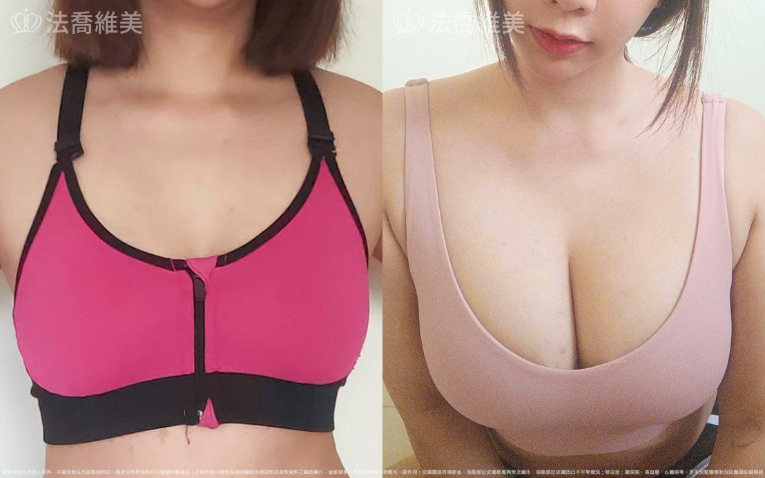 自體脂肪隆乳
