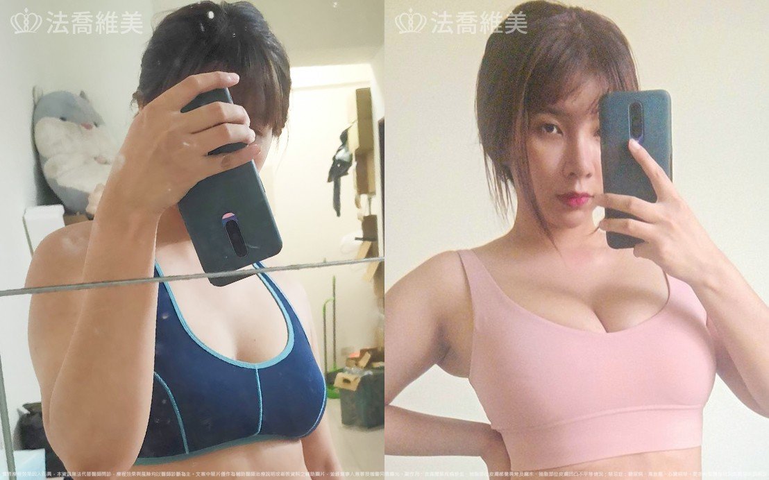 自體脂肪隆乳