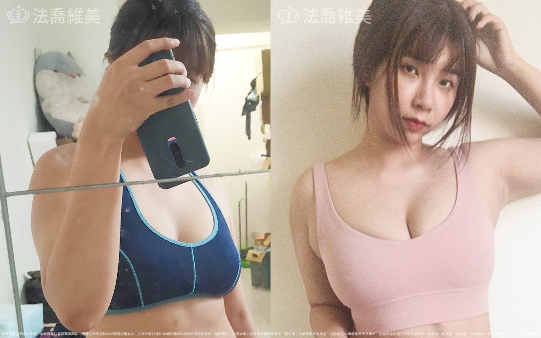 自體脂肪隆乳