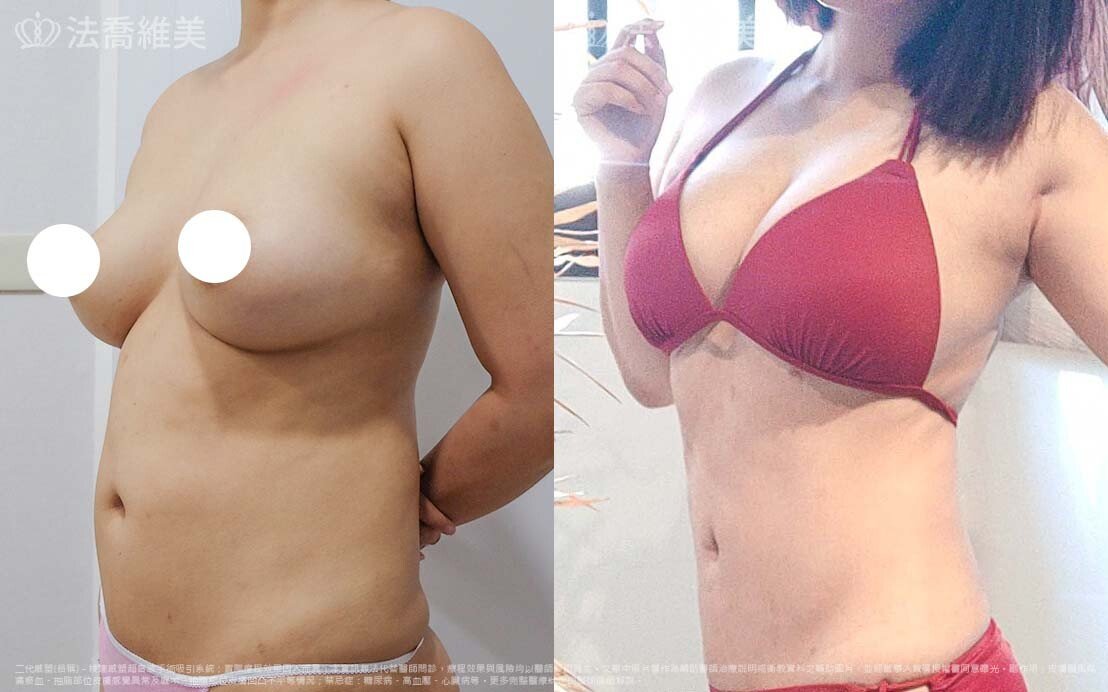自體脂肪隆乳