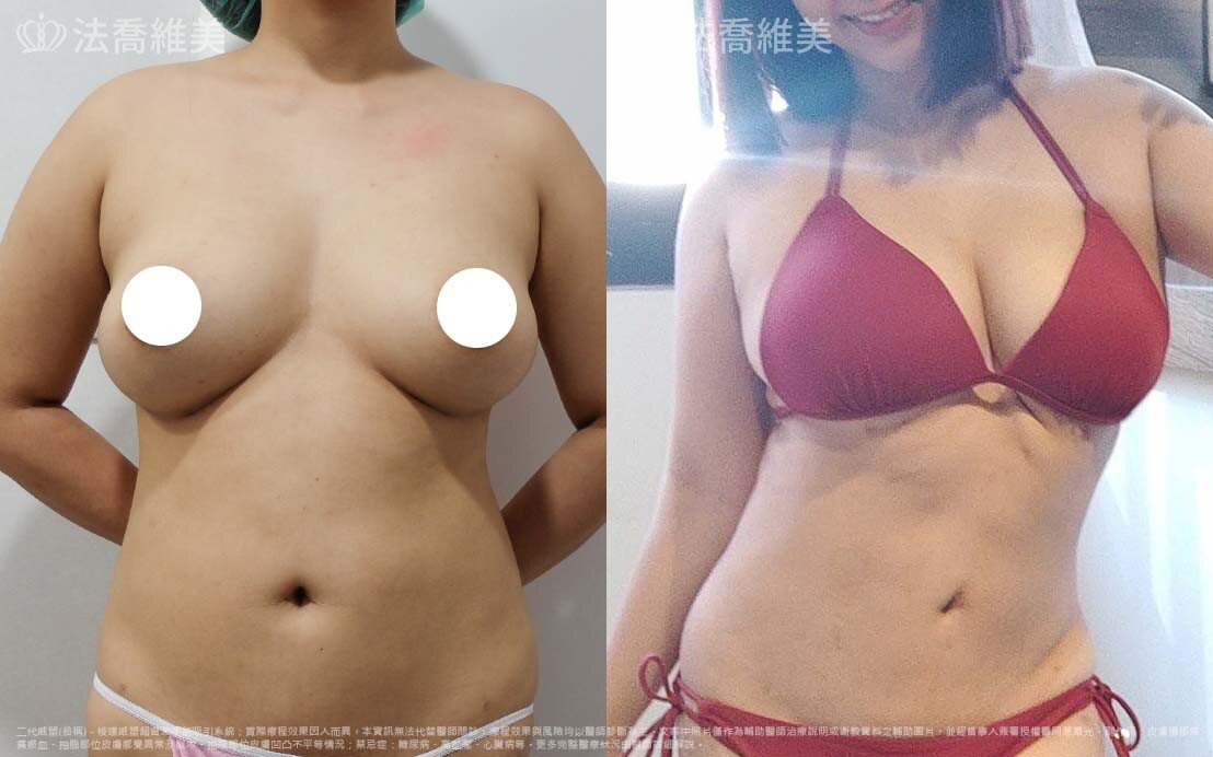 自體脂肪隆乳