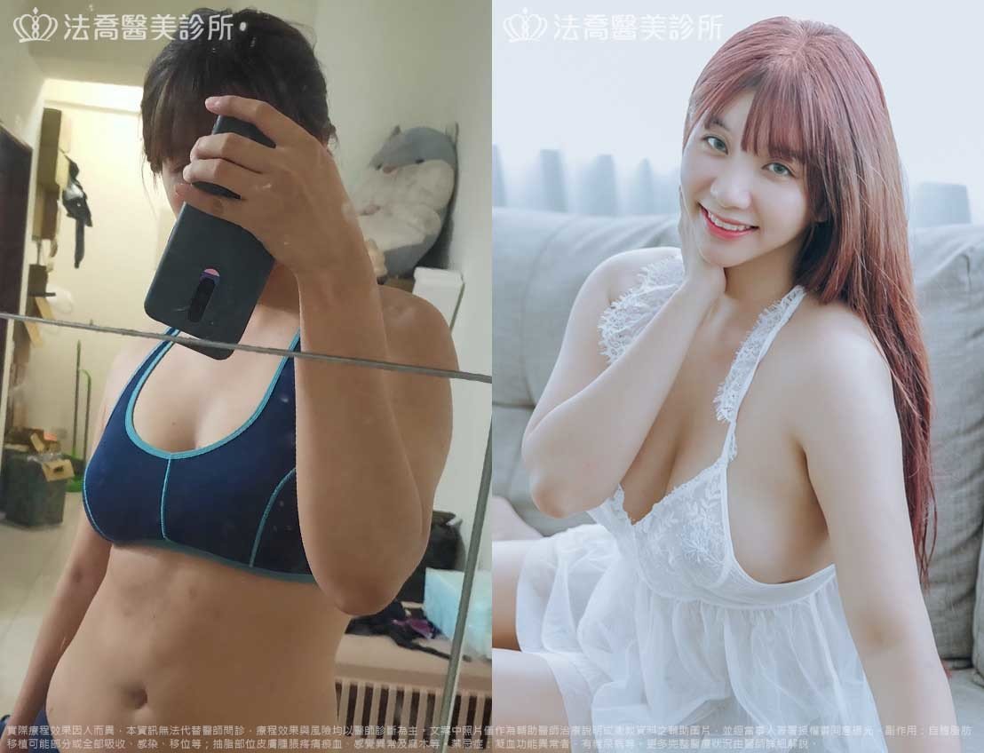 自體脂肪隆乳