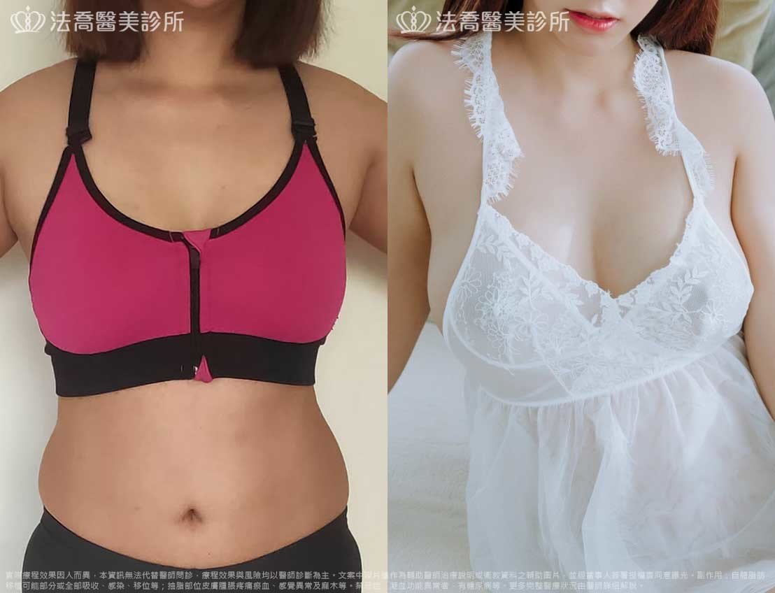 自體脂肪隆乳