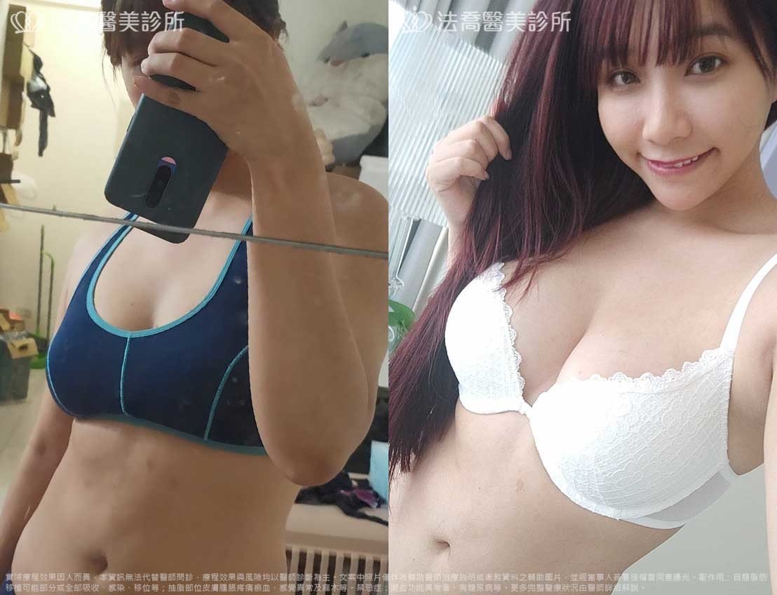 自體脂肪隆乳