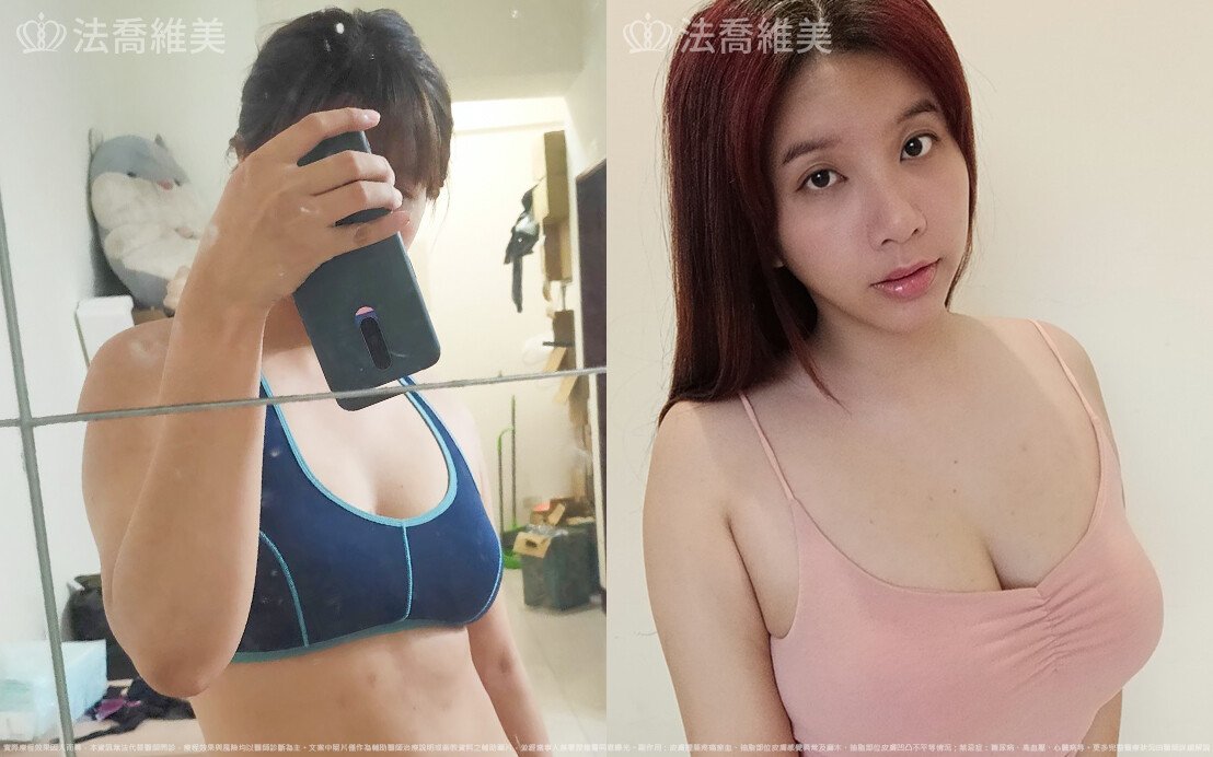自體脂肪隆乳