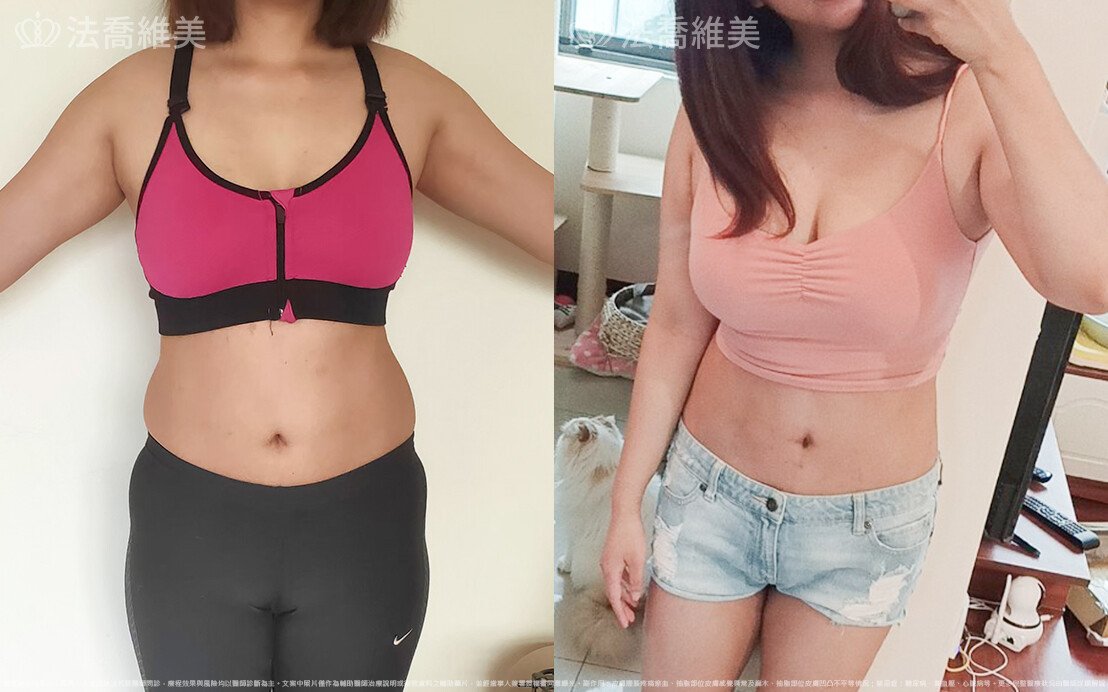 自體脂肪隆乳