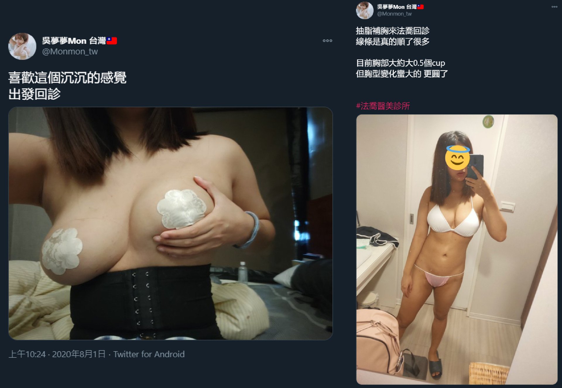 自體脂肪隆乳