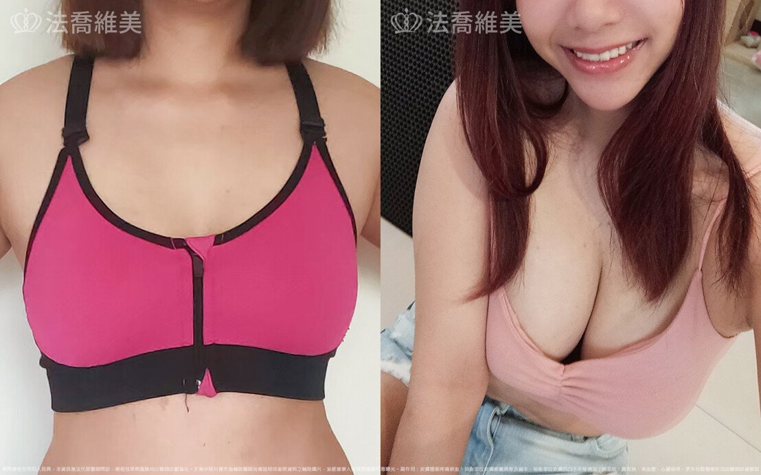 自體脂肪隆乳