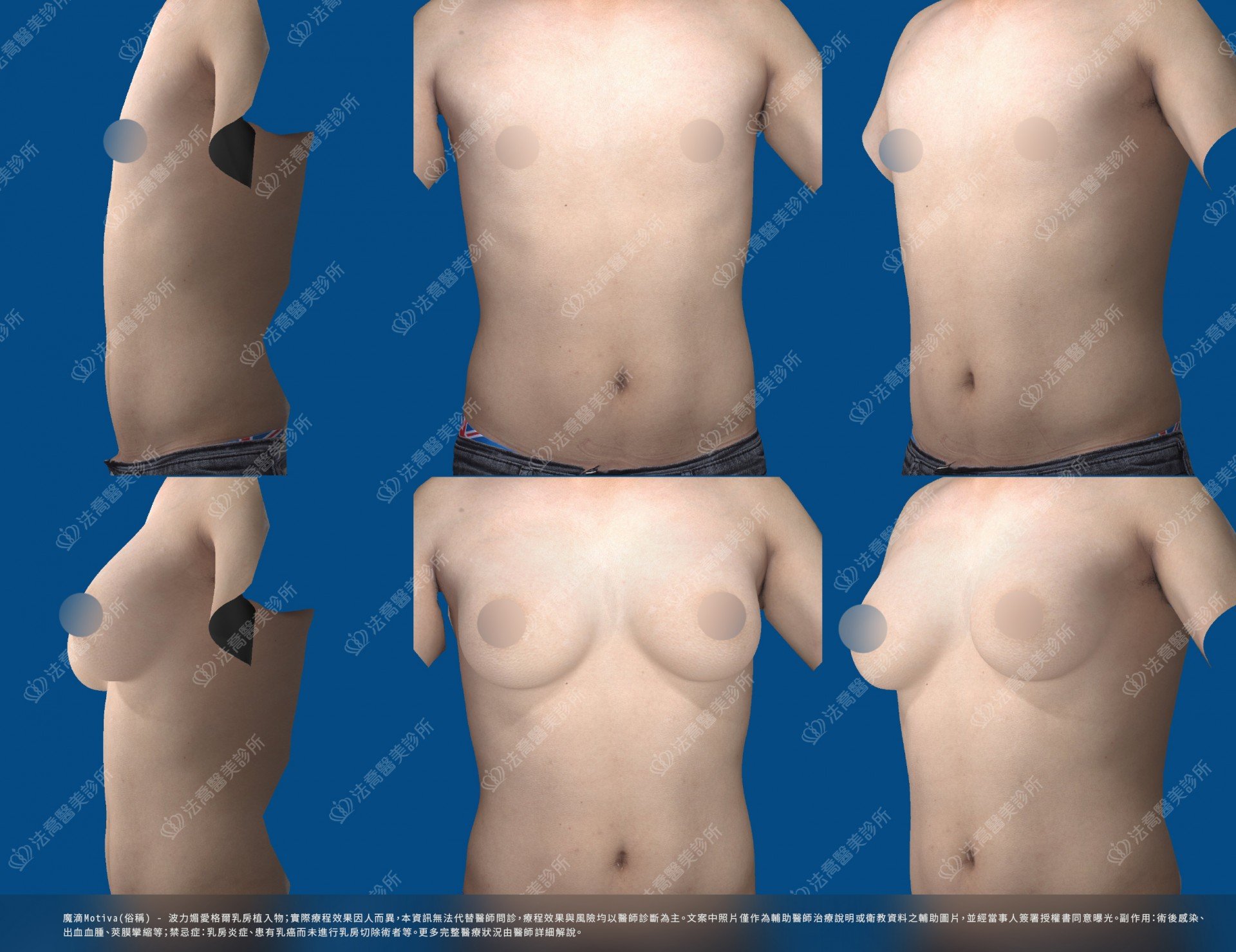 魔滴隆乳,削骨,3D影像模擬圖