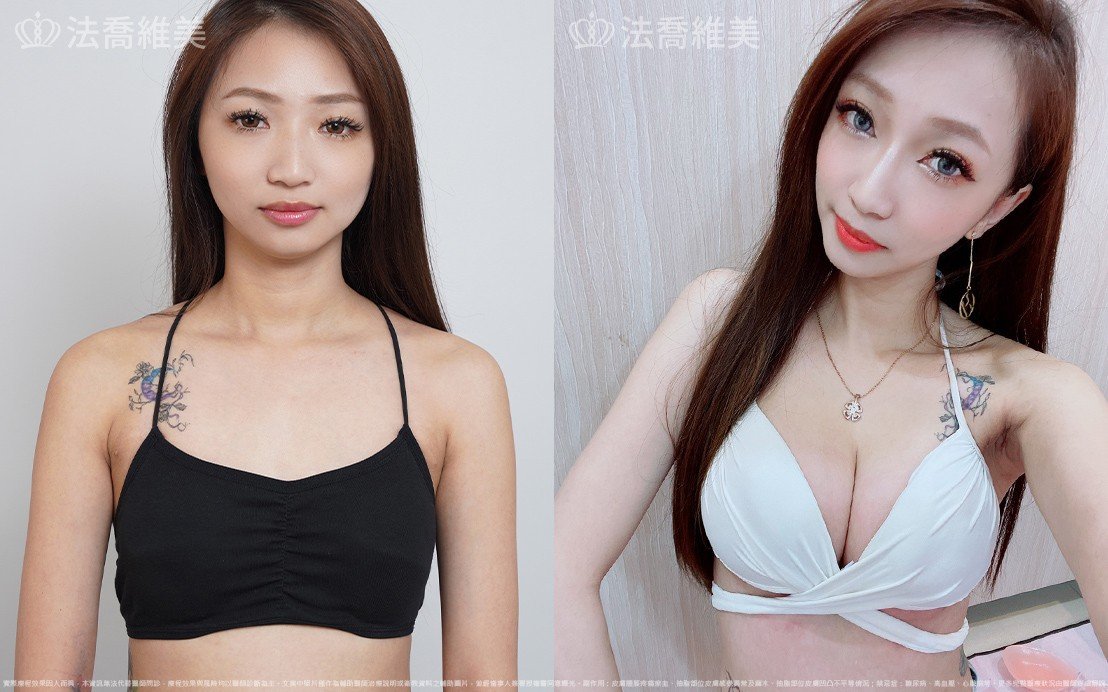 魔滴隆乳,自體脂肪隆乳