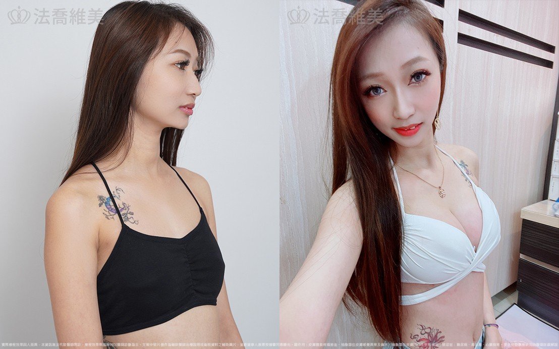 魔滴隆乳,自體脂肪隆乳