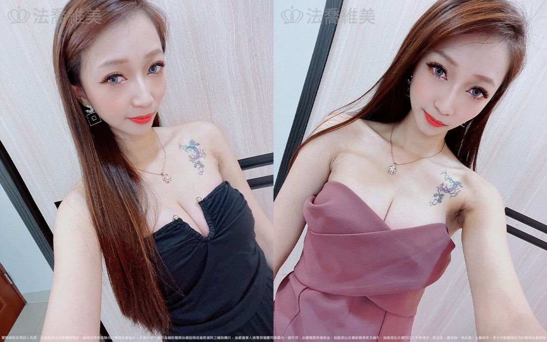 魔滴隆乳,自體脂肪隆乳