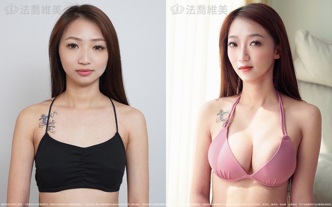 魔滴隆乳,自體脂肪隆乳