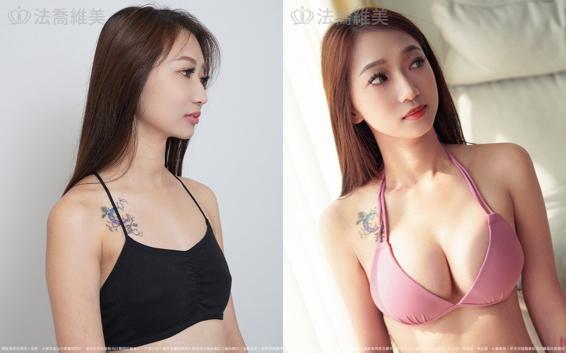 魔滴隆乳,自體脂肪隆乳