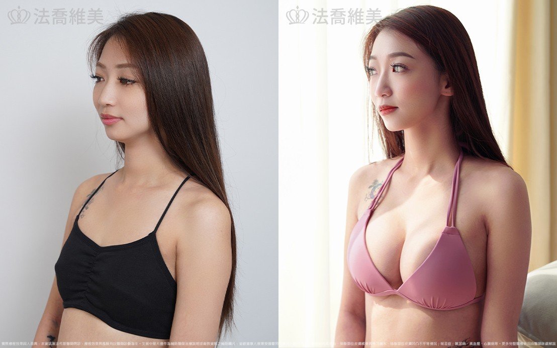 魔滴隆乳,自體脂肪隆乳