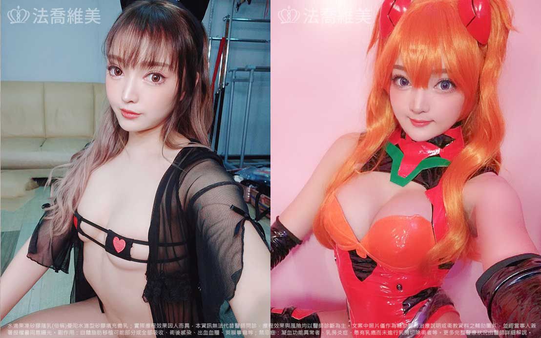 水滴型果凍矽膠隆乳,自體脂肪隆乳
