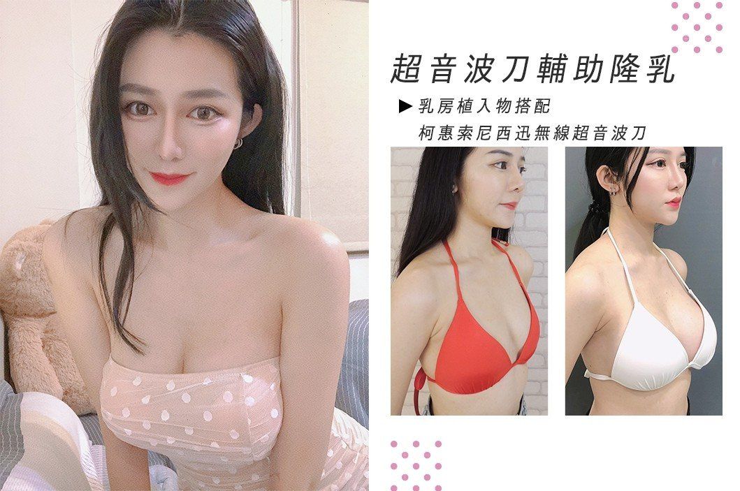 楊冪_圓盤型果凍矽膠隆乳(俗稱)合併自體脂肪豐胸心得