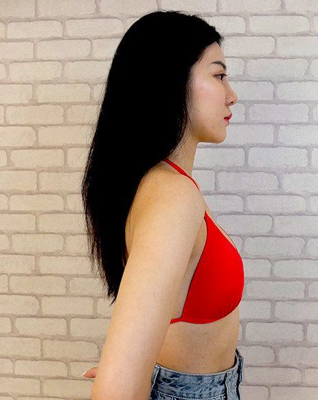 圓盤果凍矽膠隆乳,自體脂肪隆乳