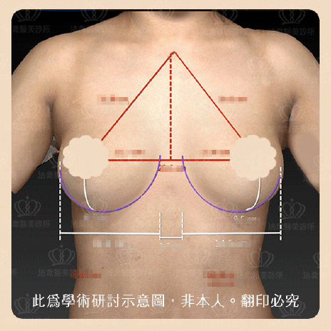 圓盤果凍矽膠隆乳,自體脂肪隆乳