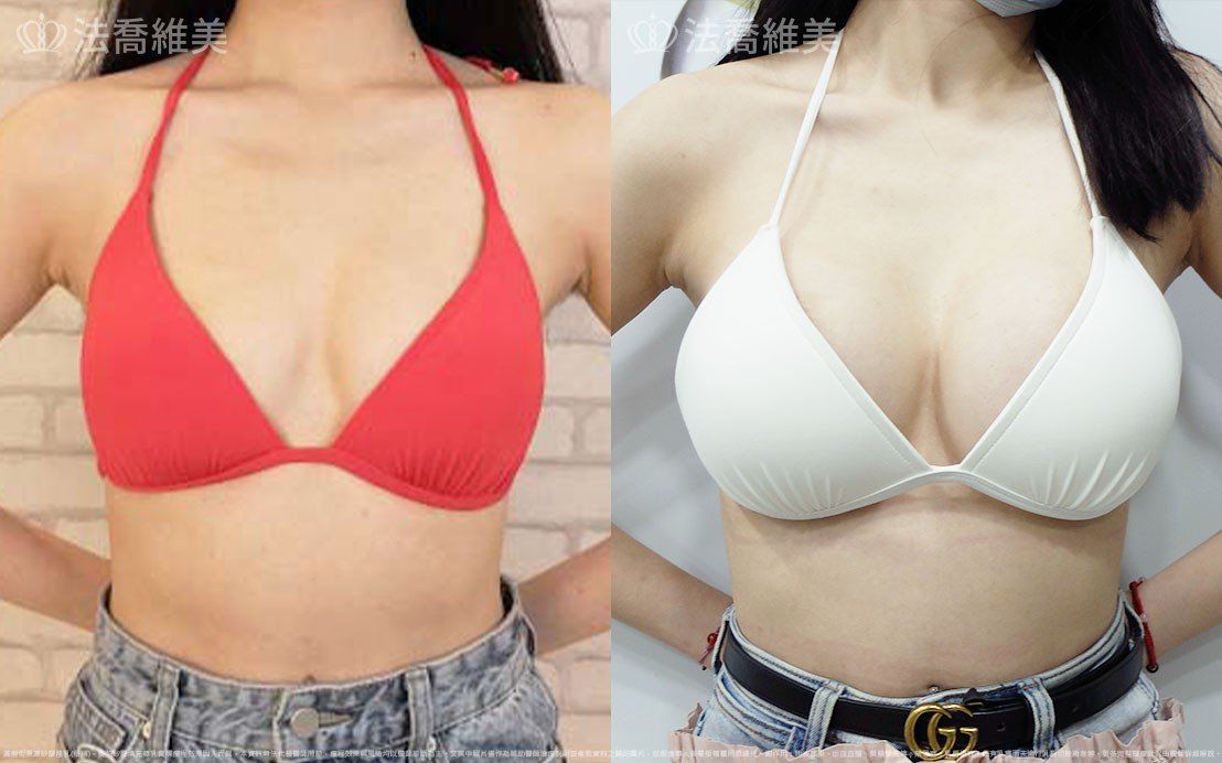 圓盤果凍矽膠隆乳,自體脂肪隆乳