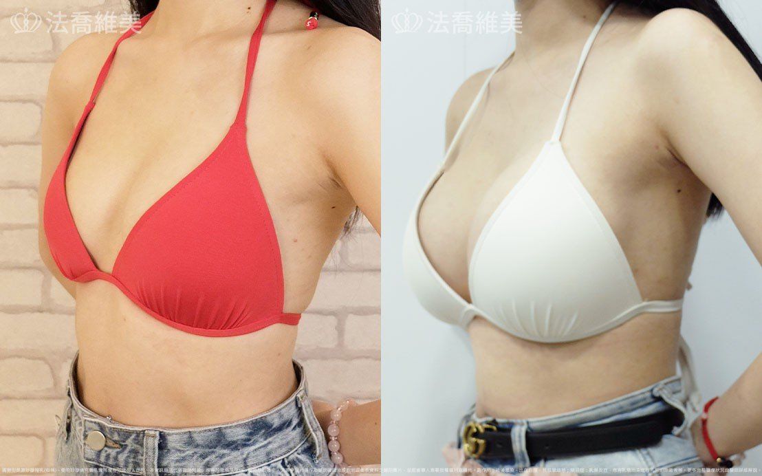 圓盤果凍矽膠隆乳,自體脂肪隆乳