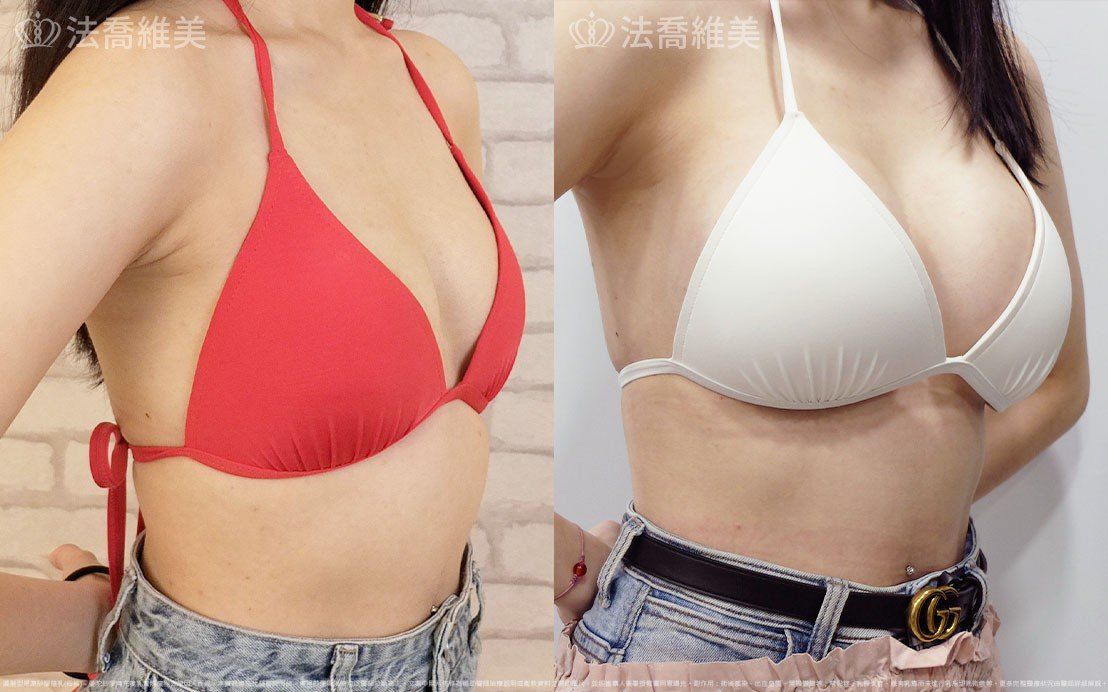 圓盤果凍矽膠隆乳,自體脂肪隆乳