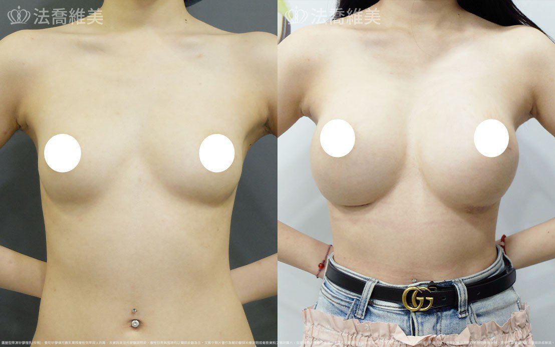 圓盤果凍矽膠隆乳,自體脂肪隆乳