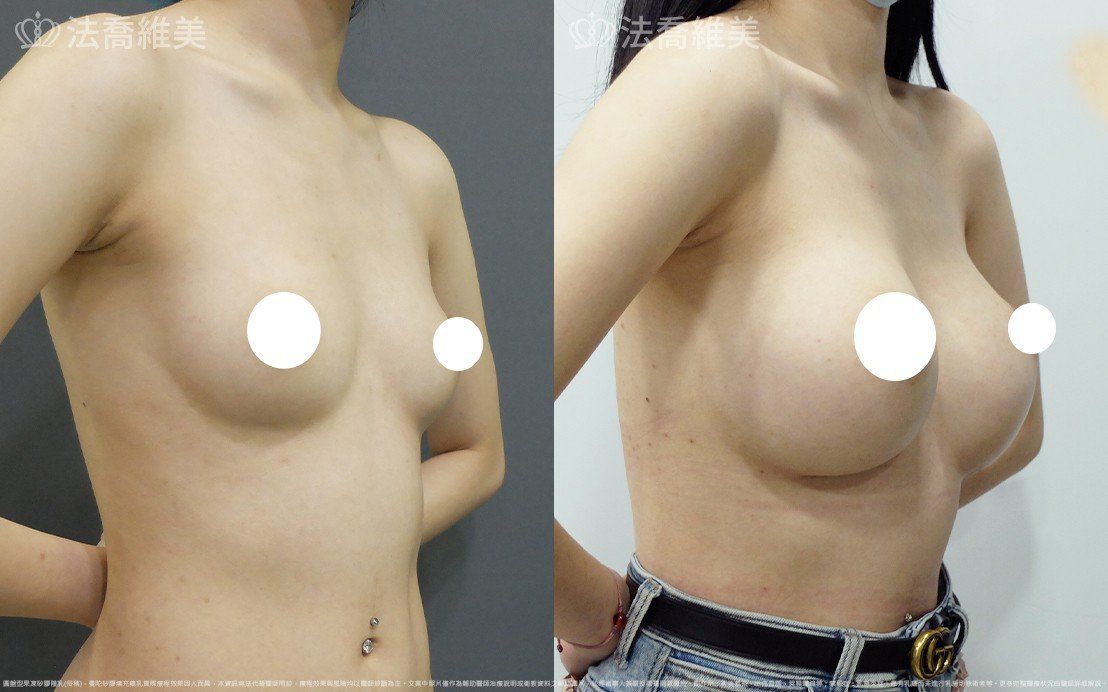 圓盤果凍矽膠隆乳,自體脂肪隆乳