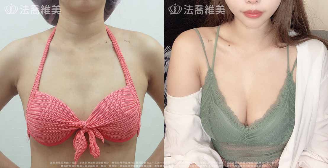 自體脂肪隆乳