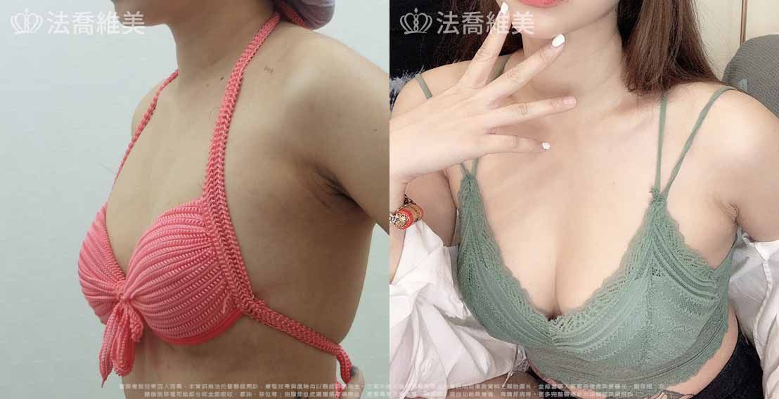 自體脂肪隆乳