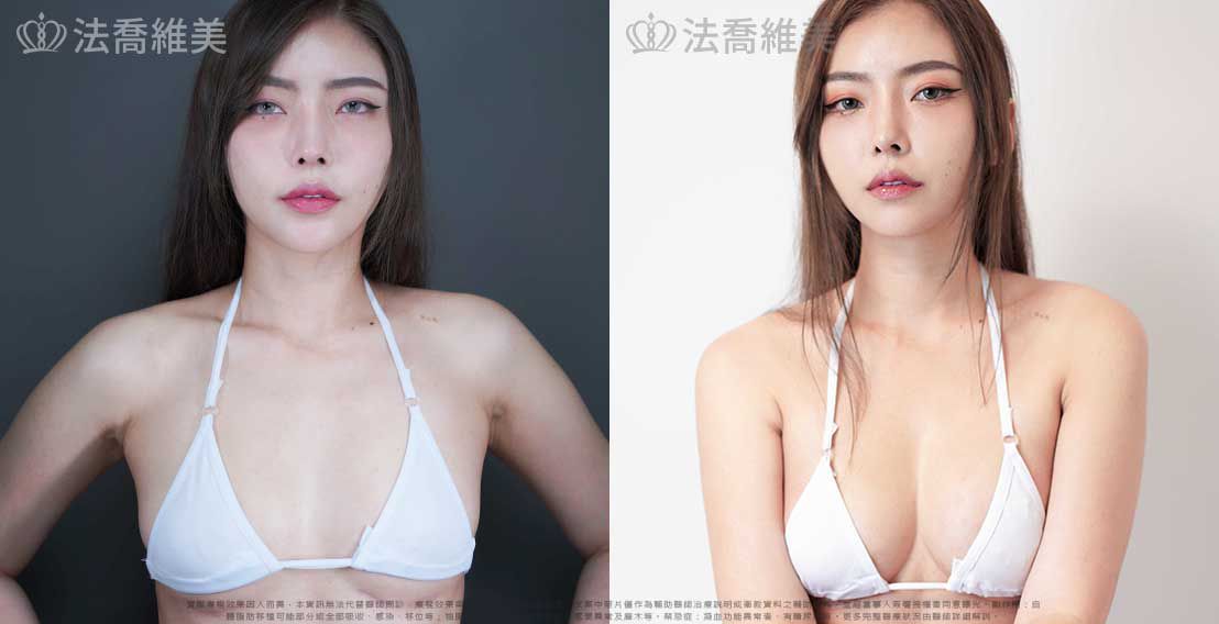 自體脂肪隆乳