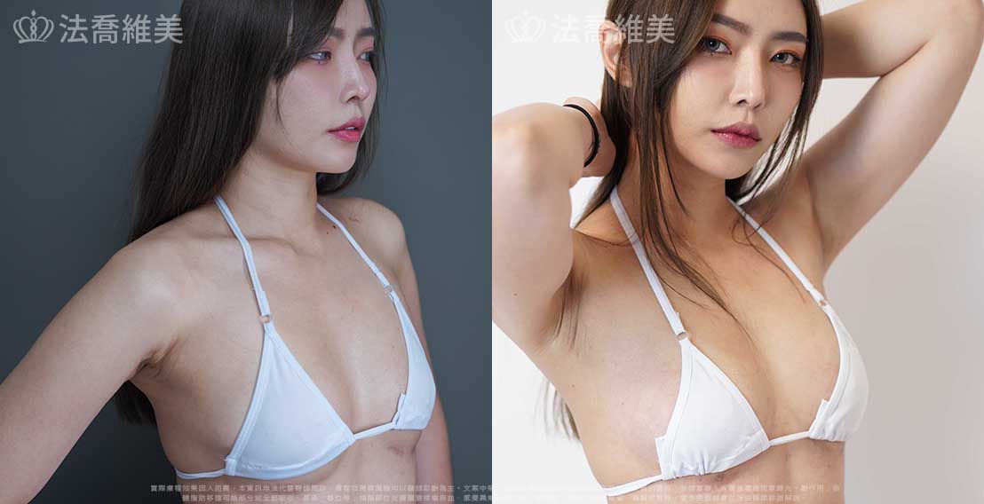 自體脂肪隆乳